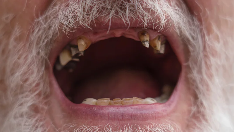 methmouth